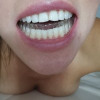 Férula dental - 1